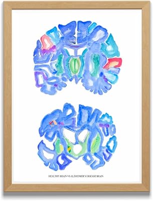 MEDPAPERS Healthy vs Alzheimers Brain Neuroscience Neurology Decor, Neurologist and Psychiatry Neuropathology Pathology Assistant Gifts, Giclee 5x7 in
