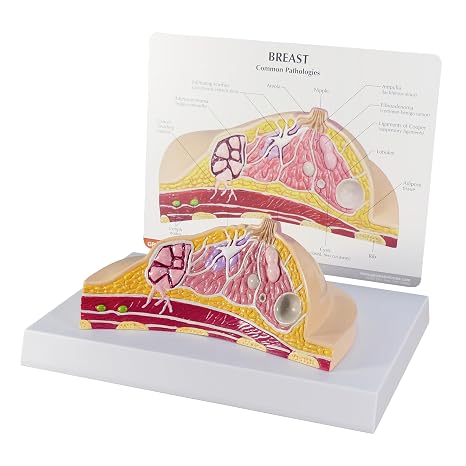 GPI Anatomicals Breast Cross-Section Model Showing Common Pathologies